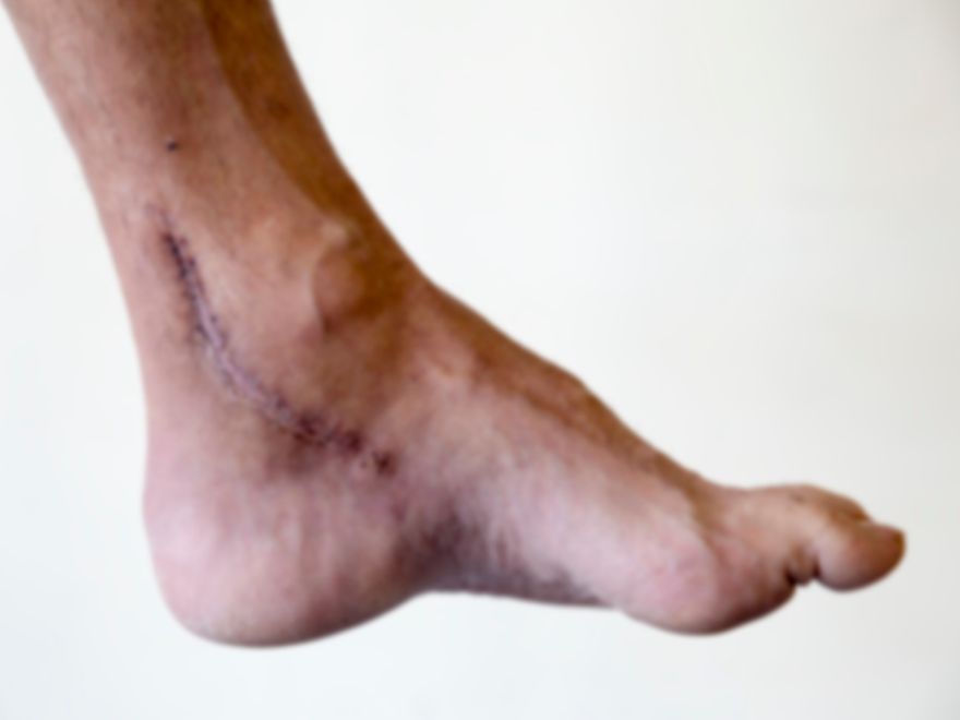 Tendon Kopmasi Ameliyati Ameliyat Com Tendon Kopmasi Ameliyati Ameliyat Com