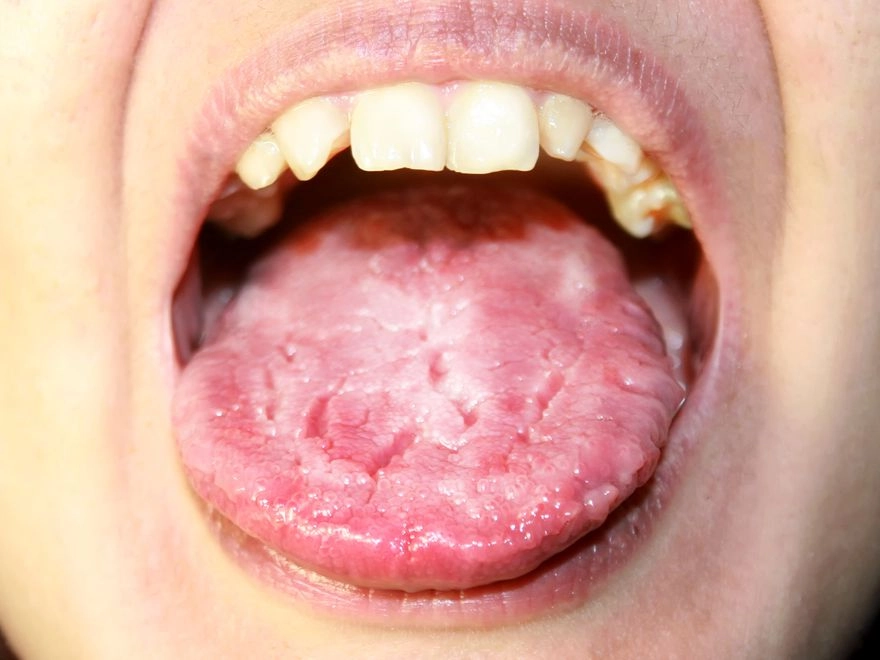 Candida Tedavisi Ameliyat Com Candida Tedavisi Ameliyat Com