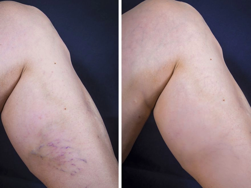 Varis Kopuk Tedavisi Ameliyat Com