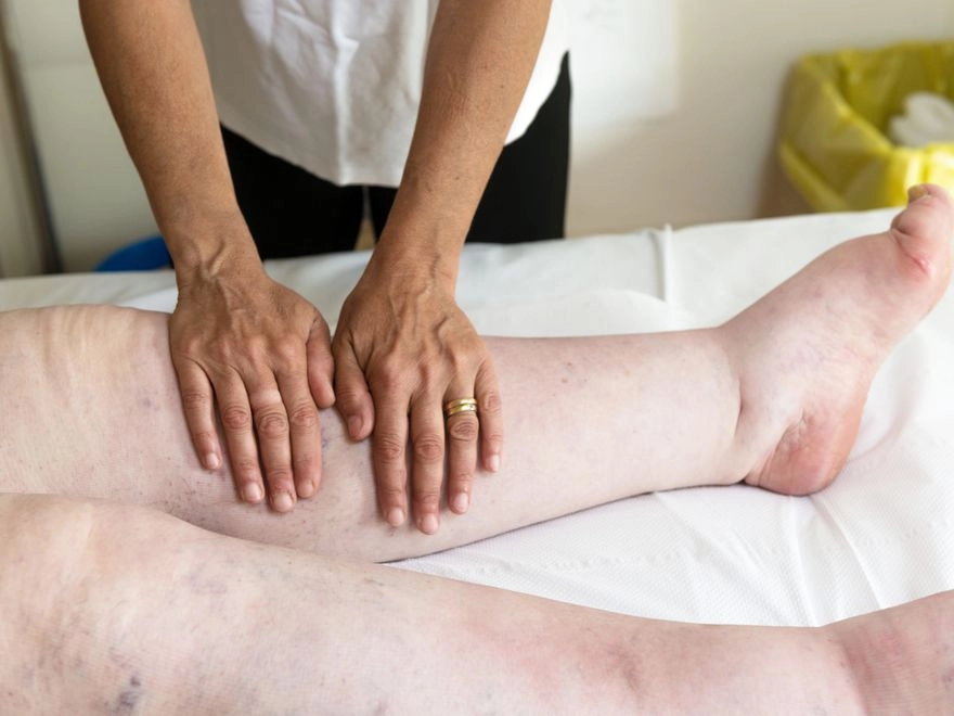 Lenf Odem Tedavisi Ameliyat Com